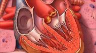 پاورپوینت Endocarditis التهاب پوشش داخلی قلب